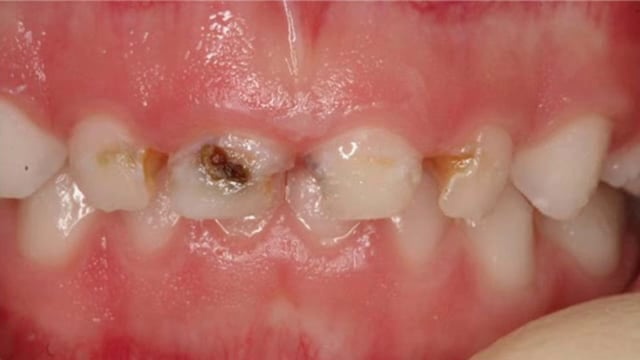 Early Childhood Caries