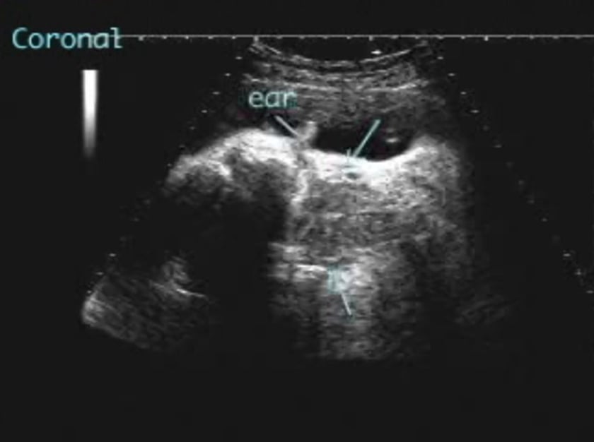 Goitre ULTRASOUNDPAEDIA