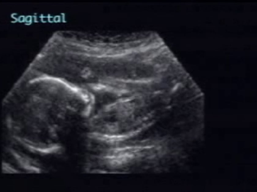 Pulmonary Hypoplasia Ultrasoundpaedia 9620