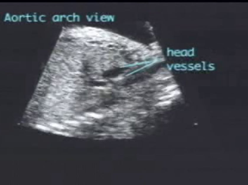 Aorta – interrupted arch – ULTRASOUNDPAEDIA