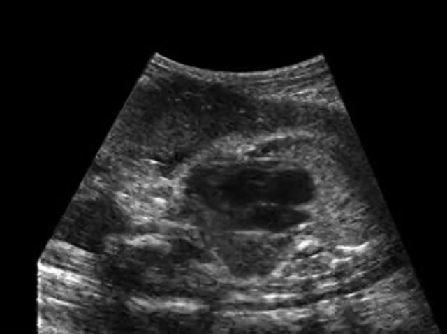 Double Inlet Ventricle – ULTRASOUNDPAEDIA