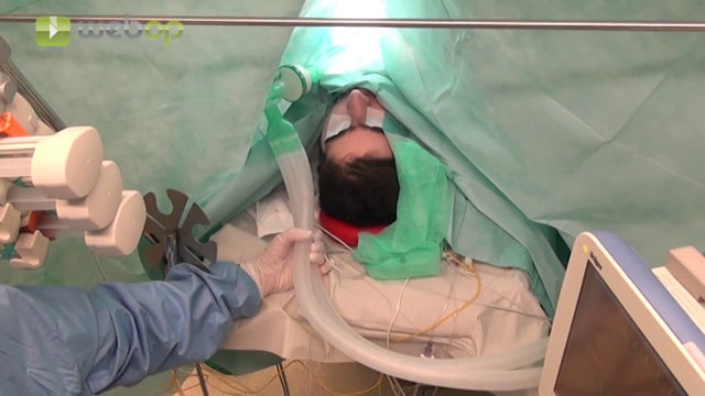 Open tracheostomy