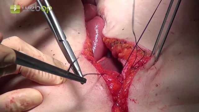 Abdominal wall closure – techniques: Loop suture and small tissue