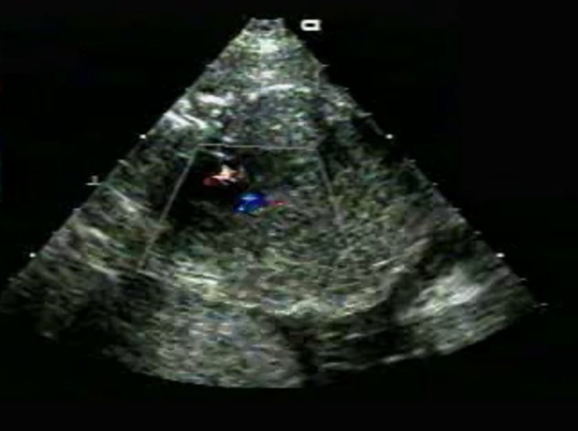 Left Atrial – Isomerism – Ultrasoundpaedia