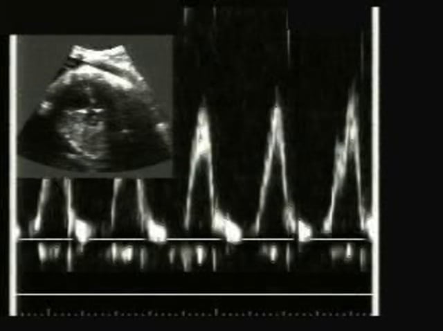 Ectopic Beats Ultrasoundpaedia