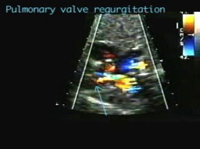 Pulmonary valve – incompetence – absent PV – ULTRASOUNDPAEDIA