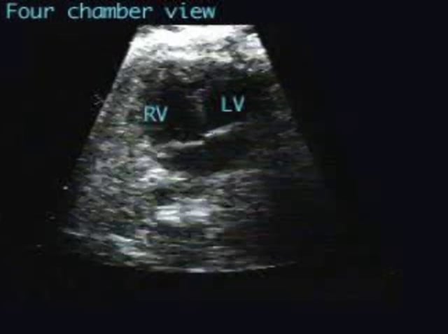 Ventricular septal defect – ULTRASOUNDPAEDIA