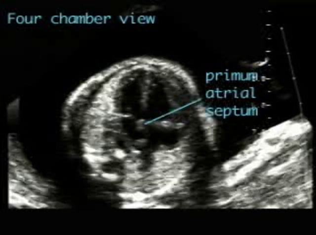 Ventricular septal defect – ULTRASOUNDPAEDIA