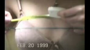Chest expansion test in a woman with ankylosing spondylitis