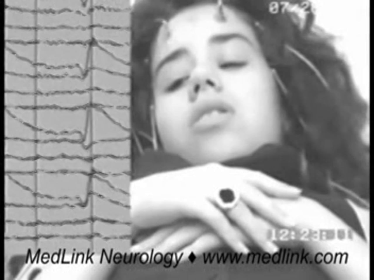 Seizure in eyelid myoclonia with absences (video-EEG)