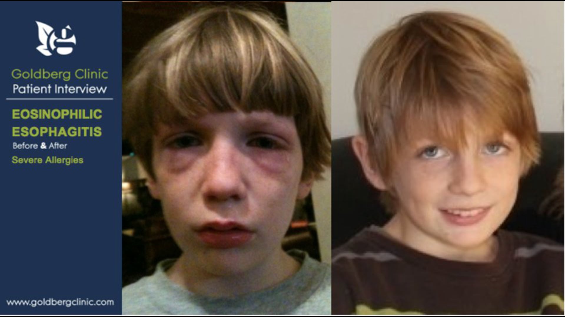 Eosinophilic Esophagitis Reversed