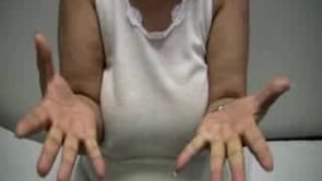 Grip myotonia in myotonic dystrophy type 2