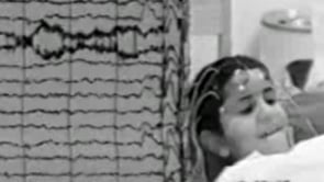 Atypical absences in Lennox-Gastaut syndrome (video-EEG)