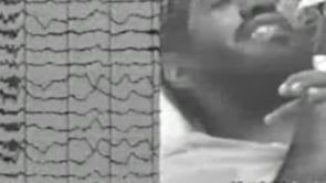 Facial tonic seizures in a man with learning difficulties and Lennox-Gastaut syndrome (video-EEG)