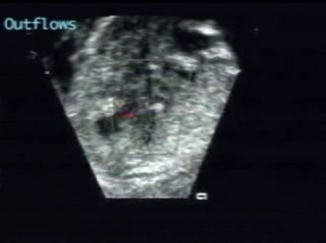 left-ventricle-echogenic-focus-ultrasoundpaedia