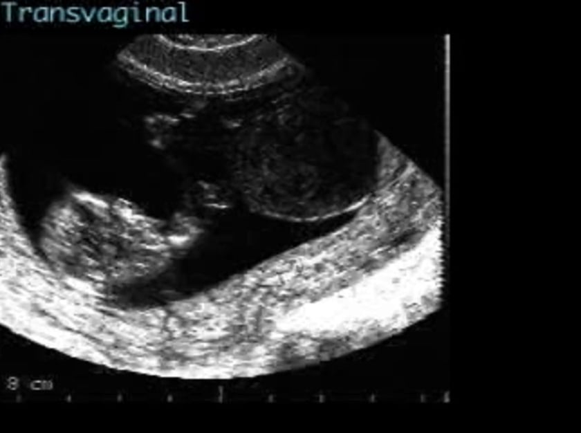 Allantoic Cyst – ULTRASOUNDPAEDIA