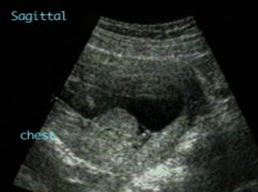 Body stalk anomaly – ULTRASOUNDPAEDIA