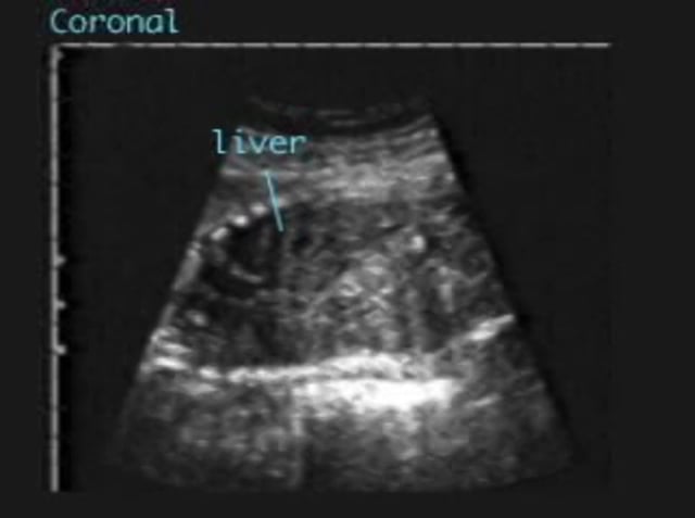 Cirrhosis – ULTRASOUNDPAEDIA