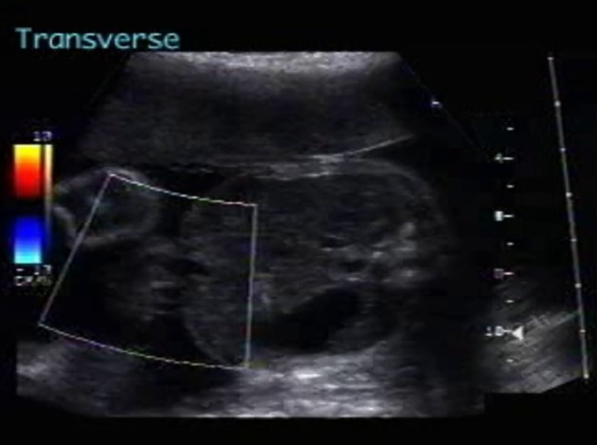 Omphalocele (Exomphalos) – ULTRASOUNDPAEDIA