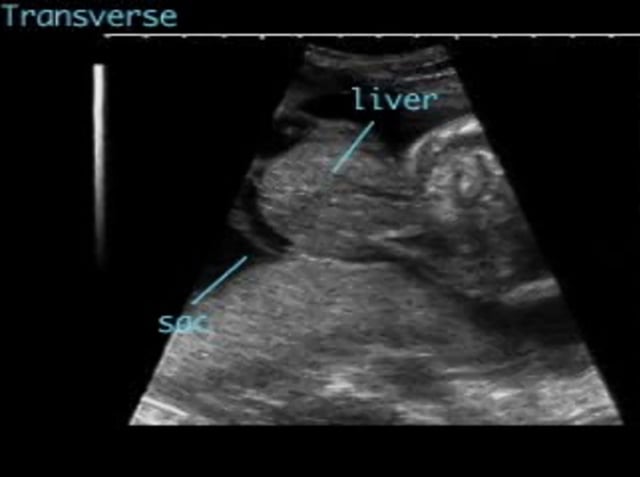 Omphalocele (Exomphalos) – ULTRASOUNDPAEDIA