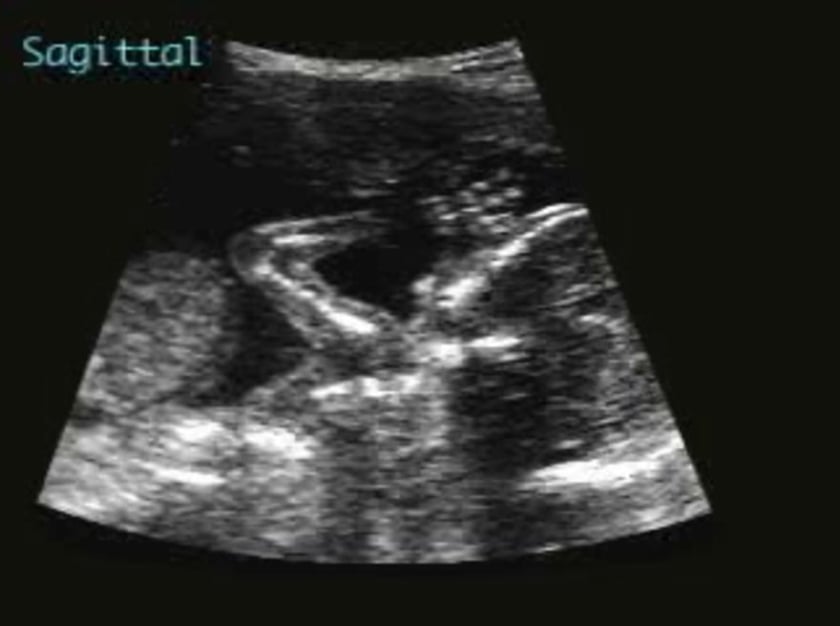 Omphalocele (Exomphalos) – ULTRASOUNDPAEDIA