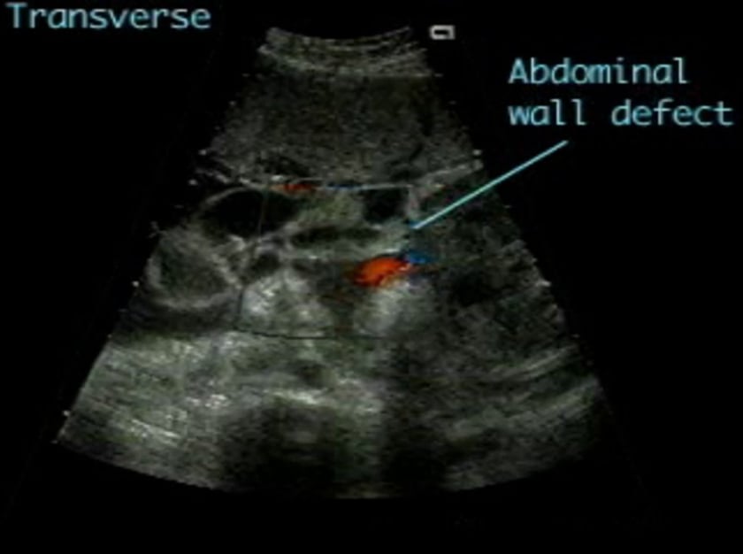 Gastroschisis – ULTRASOUNDPAEDIA