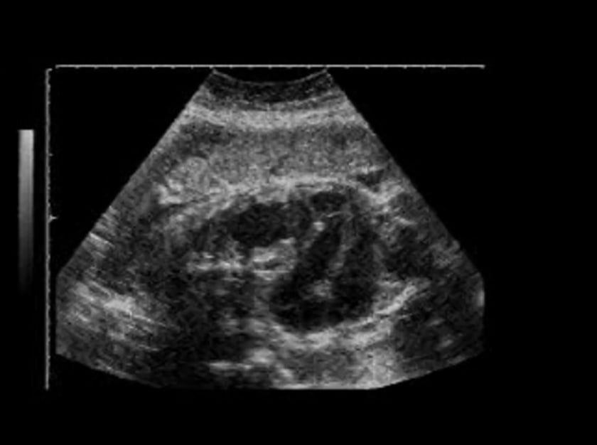 Ileal atresia – ULTRASOUNDPAEDIA