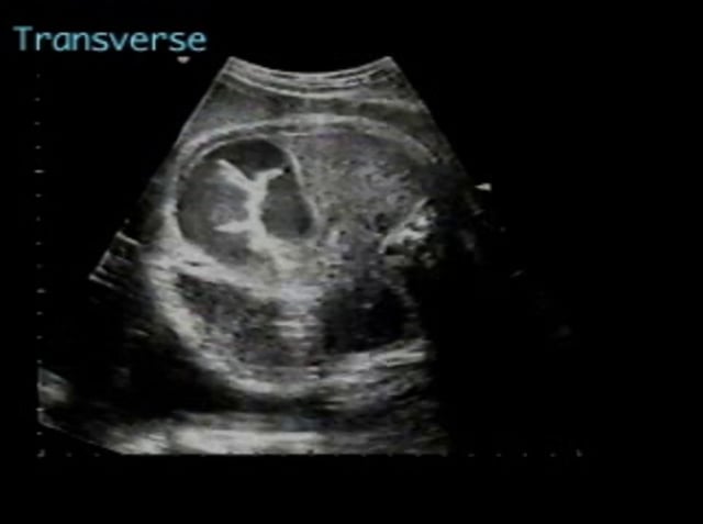 Ileal atresia – ULTRASOUNDPAEDIA