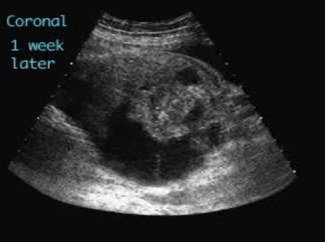 Meconium Peritonitis Ultrasoundpaedia