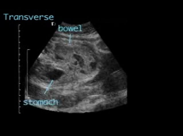 Volvulus – ULTRASOUNDPAEDIA