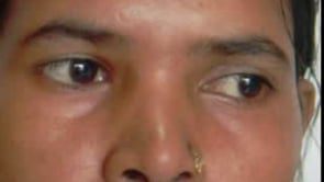 Downbeat nystagmus