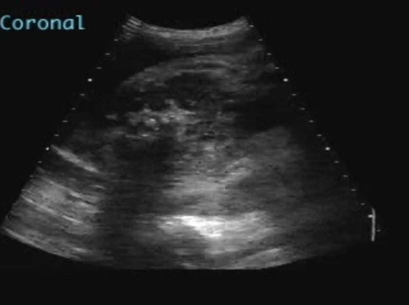 Horseshoe kidney ULTRASOUNDPAEDIA