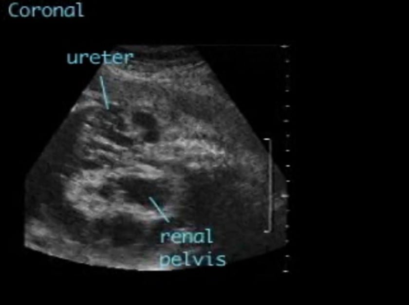 mild hydronephrosis ultrasound