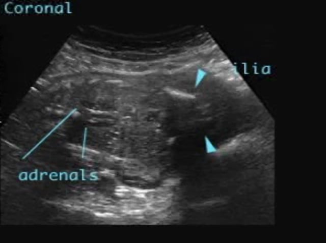 Bilateral Renal Agenesis ULTRASOUNDPAEDIA