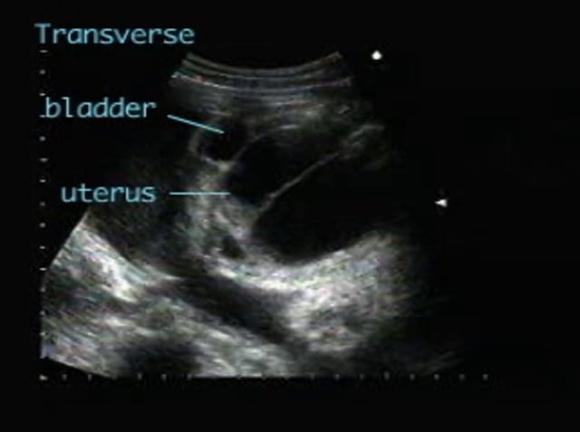 Hydrocolpos – ULTRASOUNDPAEDIA