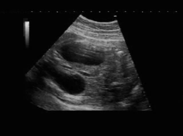 Perinephric Urinoma – Ultrasoundpaedia