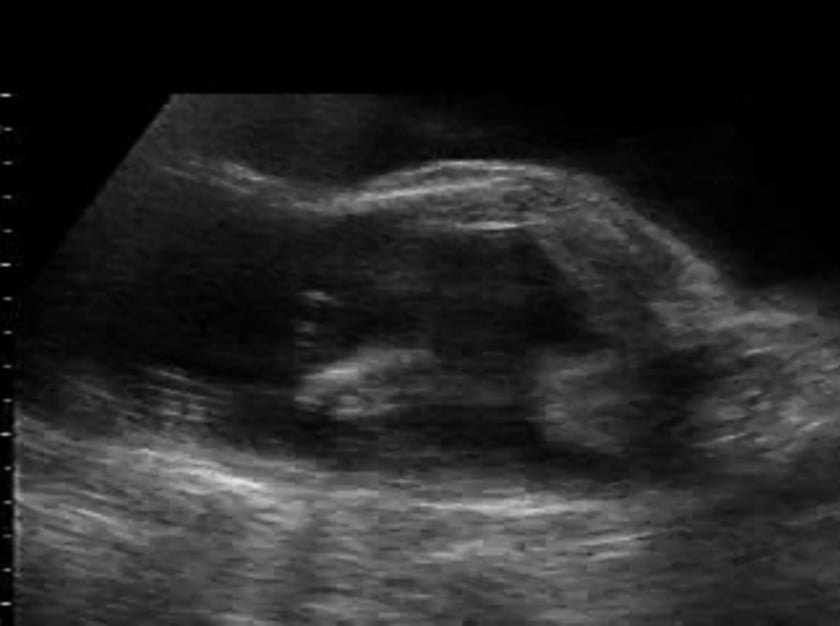 polyhydramnios ultrasound