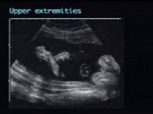 Arthrogryposis – ULTRASOUNDPAEDIA