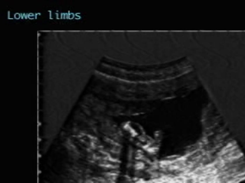 Campomelic dysplasia ULTRASOUNDPAEDIA