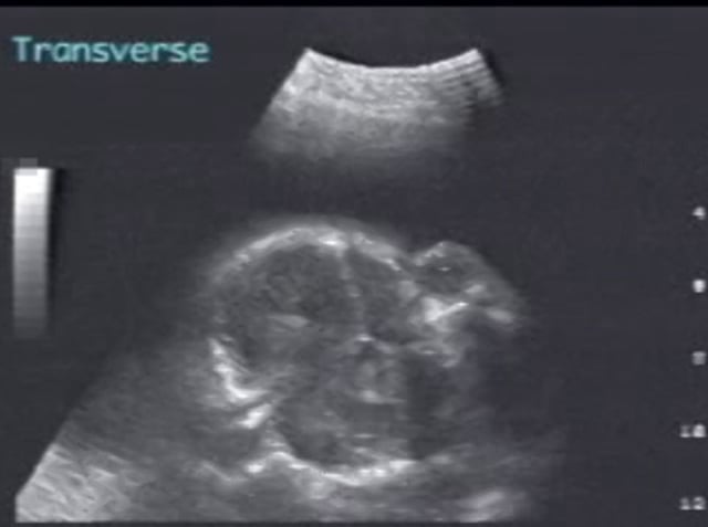 Thanatophoric dysplasia – ULTRASOUNDPAEDIA