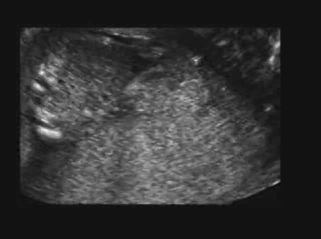 Thrombocytopenia radial aplasia – ULTRASOUNDPAEDIA