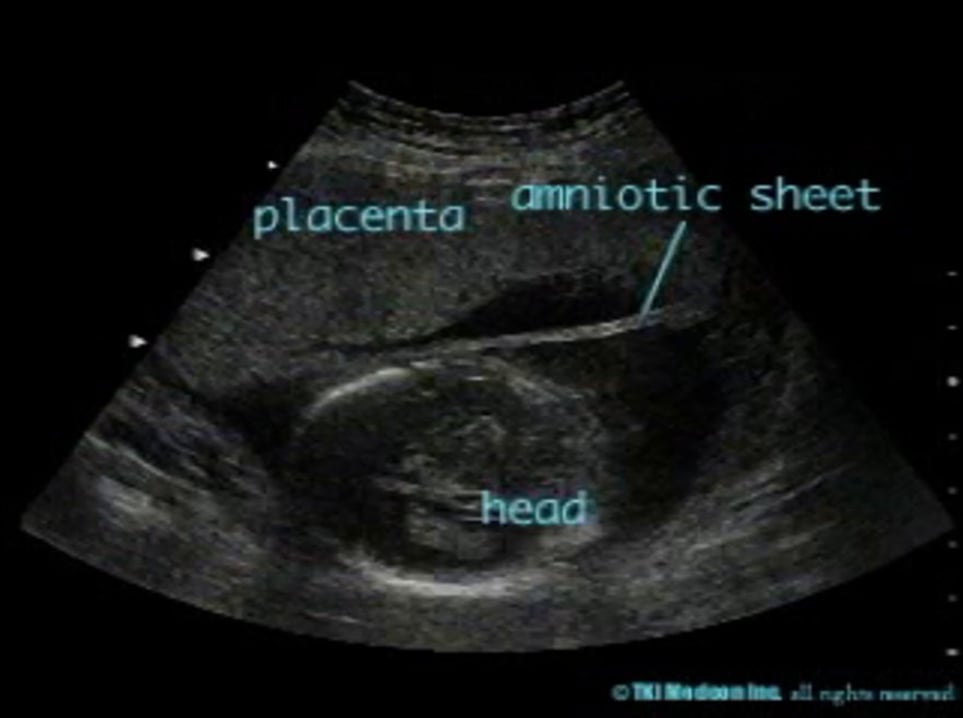 802000-amniotic-sheet-on-vimeo