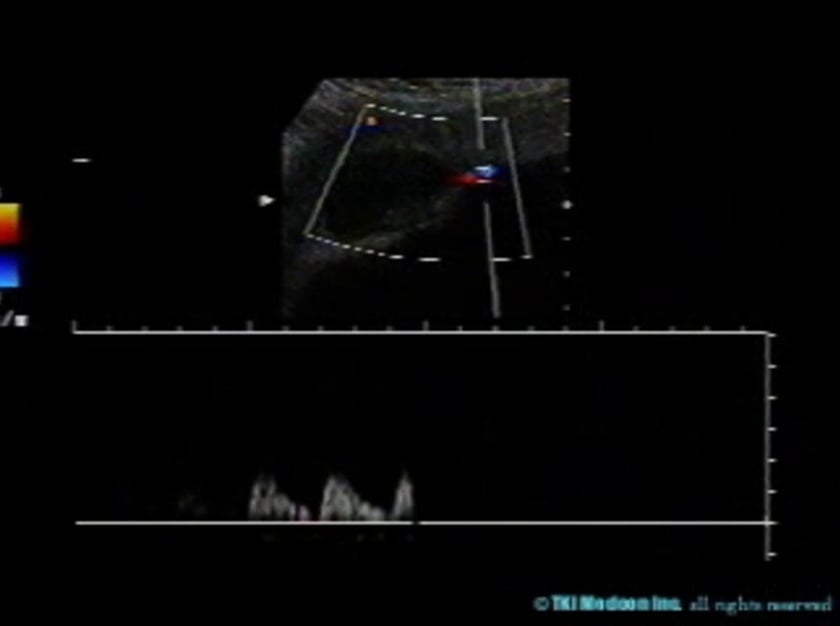 Chorioangiomas – ULTRASOUNDPAEDIA