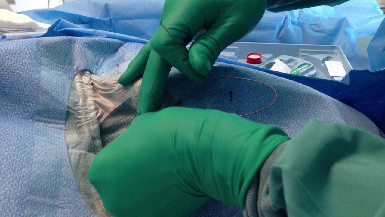 Central Venous Catheter (CVC) insertion at left internal jugular site ...