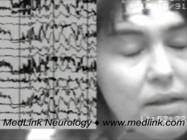Eyelid myoclonia with absences (video-EEG)