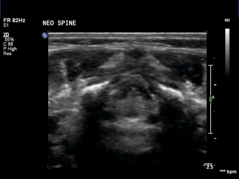 conus medullaris ultrasound