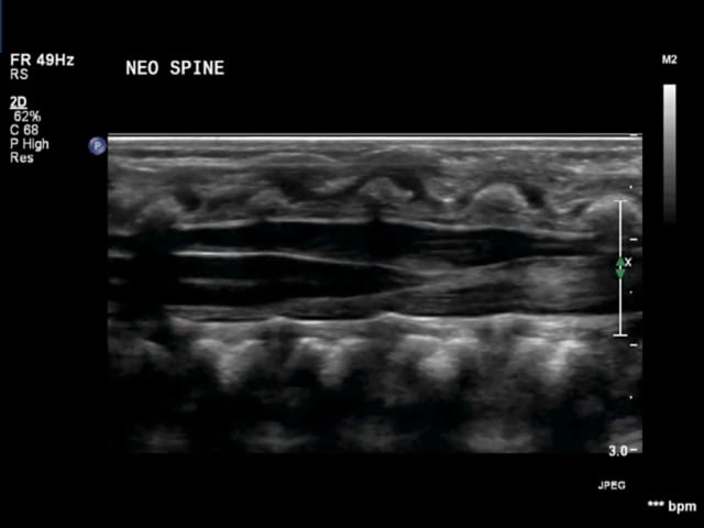 Neonatal Spine Normal – ULTRASOUNDPAEDIA