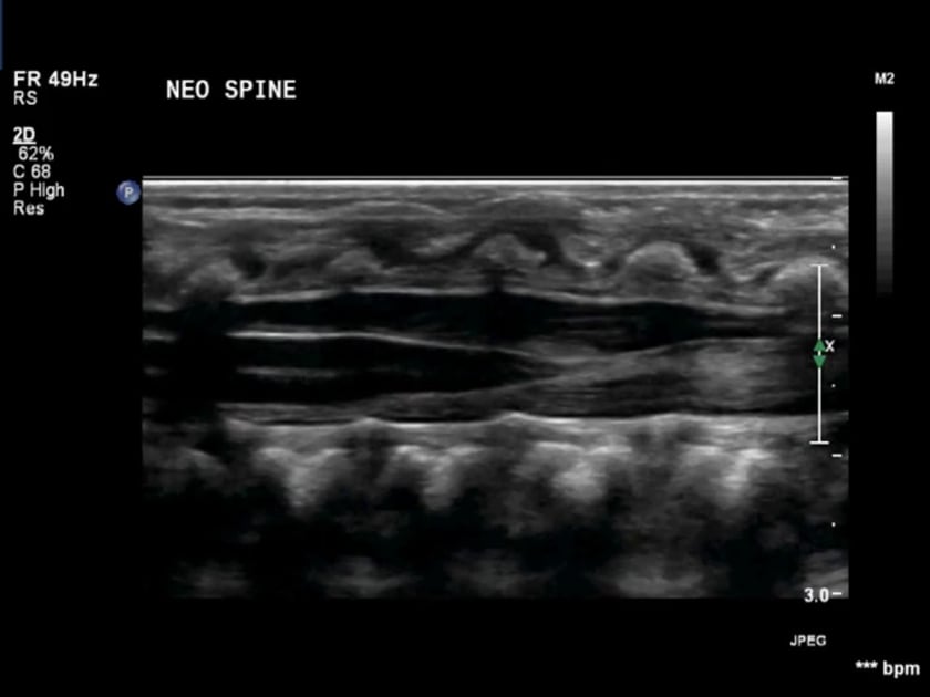 conus medullaris ultrasound