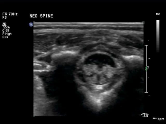 Neonatal Spine Normal – ULTRASOUNDPAEDIA