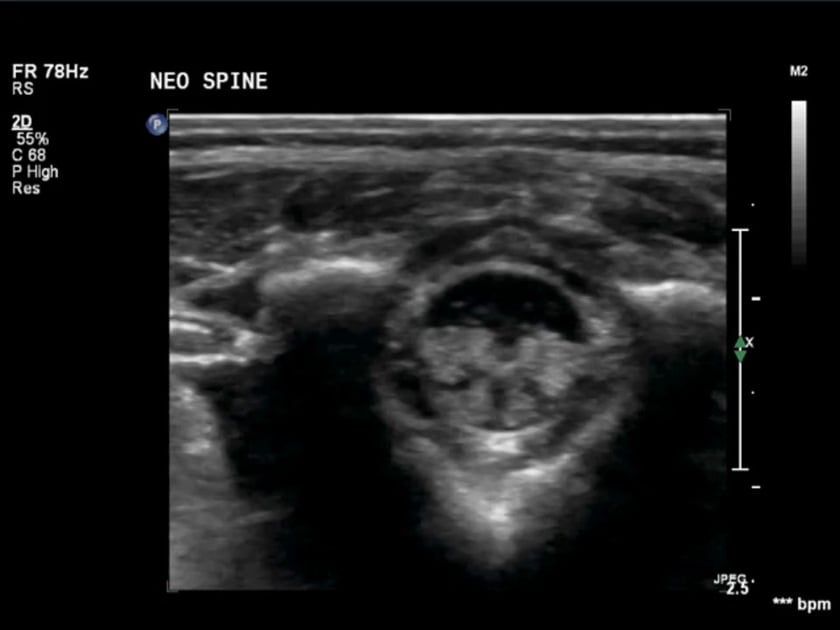 conus medullaris ultrasound